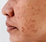 dark spot/pigmentation
