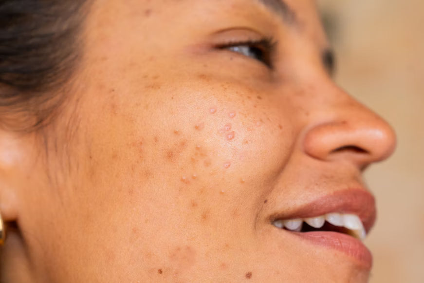 acne/oillyness